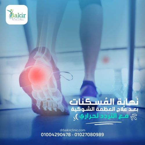 علاج الشوكة العظمية 