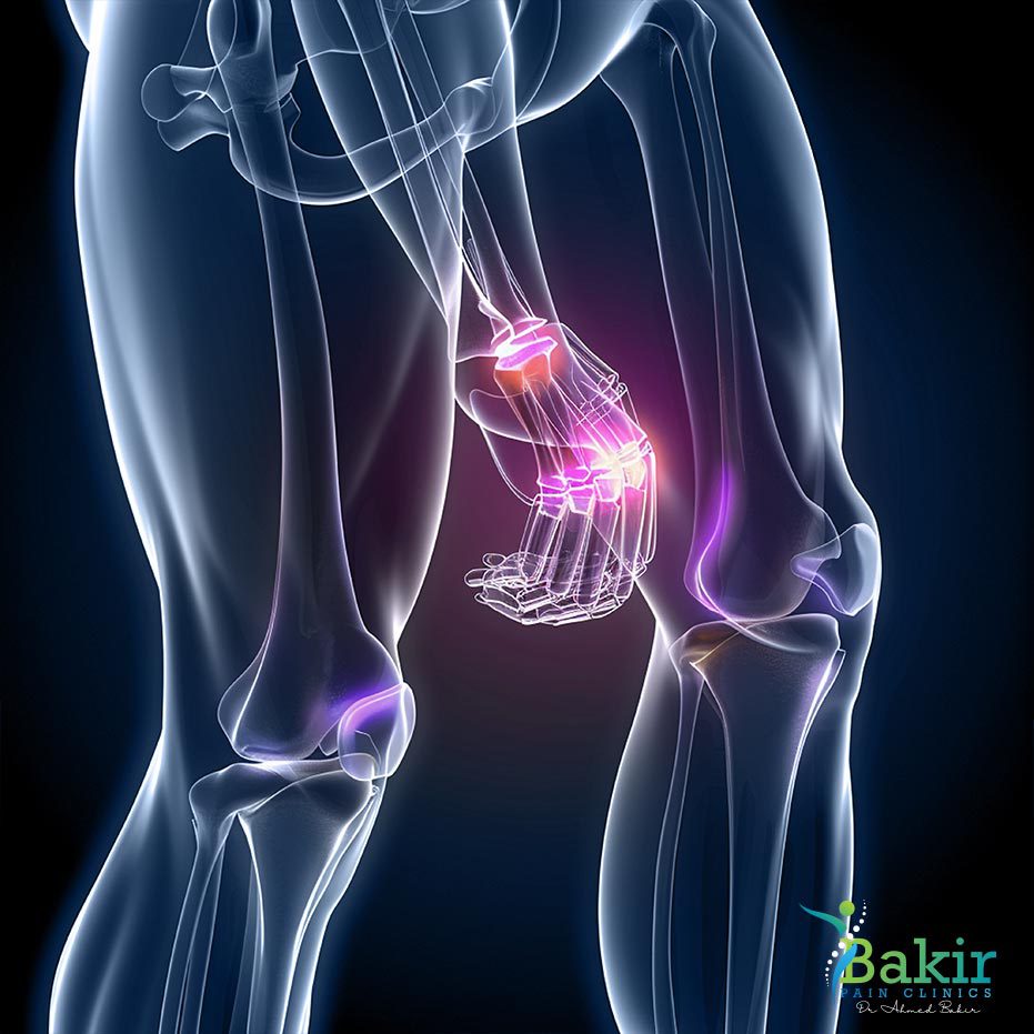 علاج التهاب المفاصل